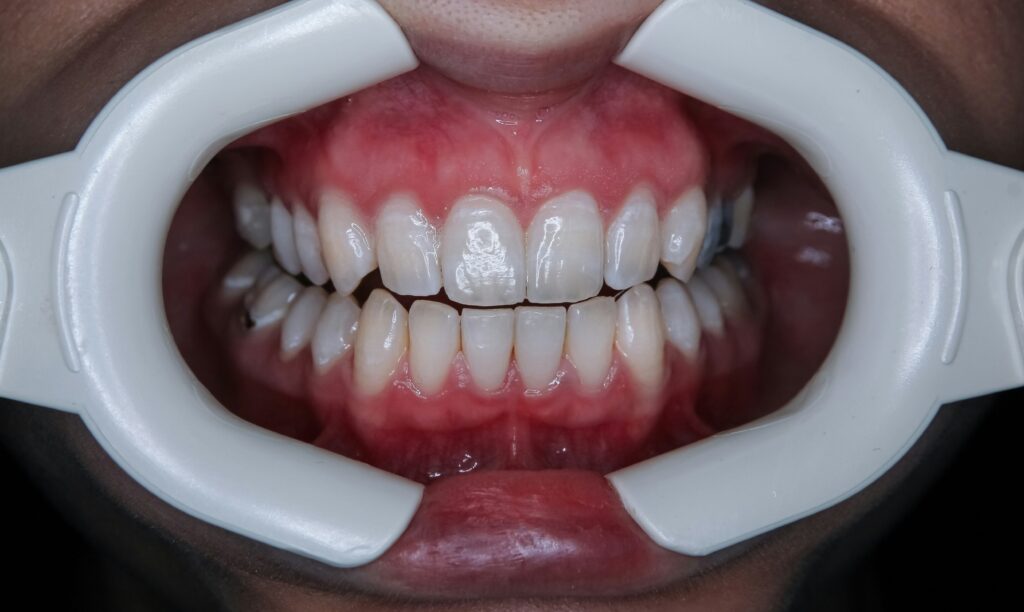 BLANQUEAMIENTO DE DIENTES